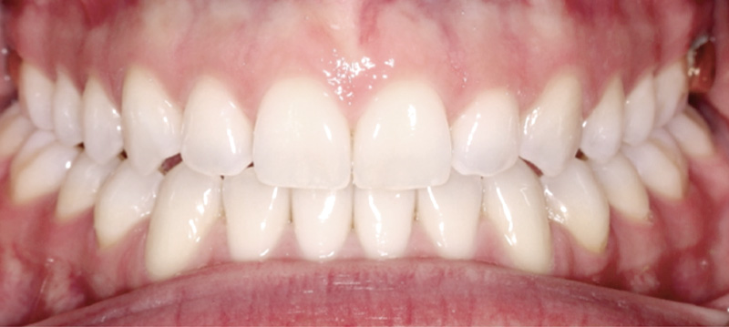 crossbite-after