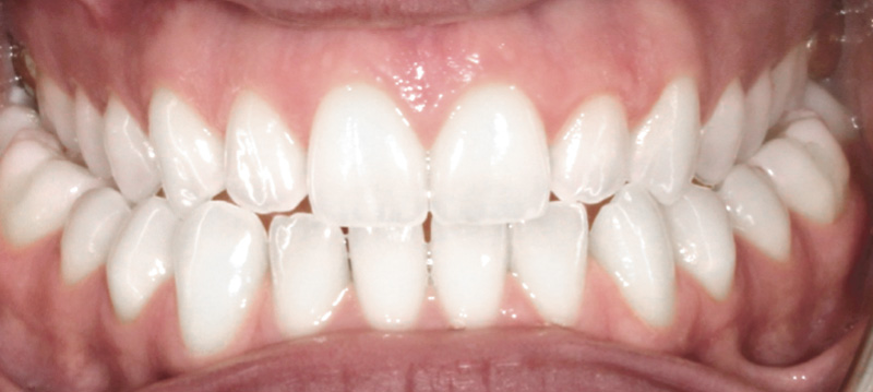 crossbite-before